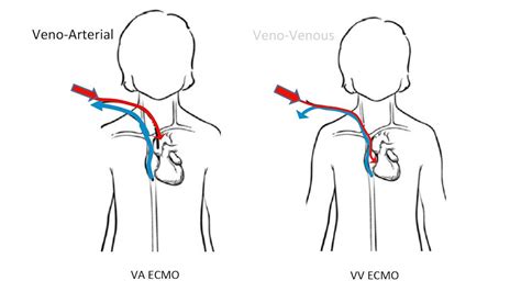 vv ecmo location